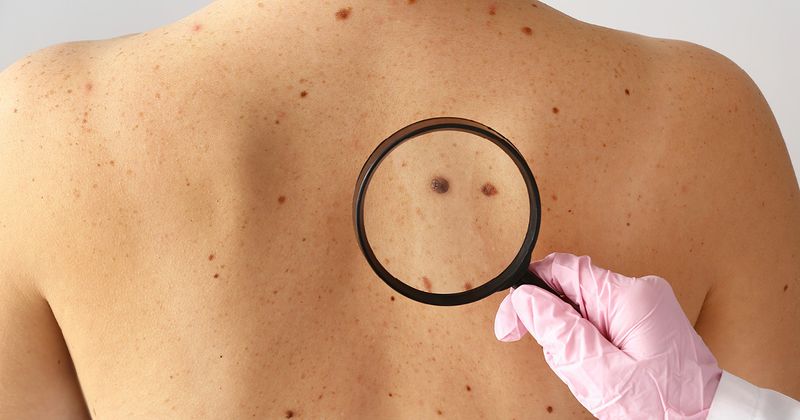 Top 4 Treatments for Skin Cancer and How They’re Done